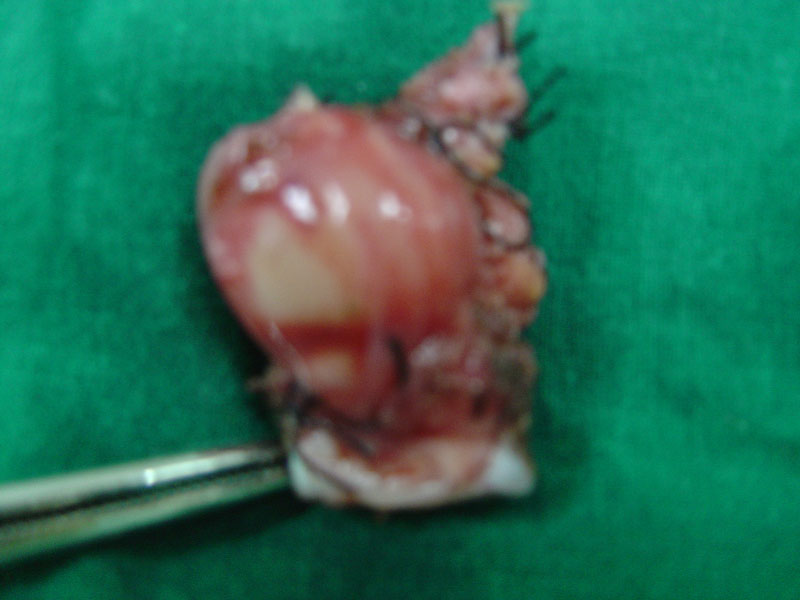 t-g-cyst